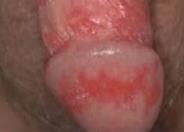 HSV2 - Genital Herpes