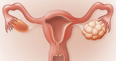 Managing Your PCOS and Its Complications