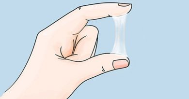 Cervical Mucus Inconsistency and Infertility