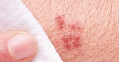 Treatment protocol for Genital Herpes