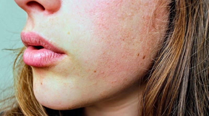 Six natural home remedies to treat itchy and dry skin