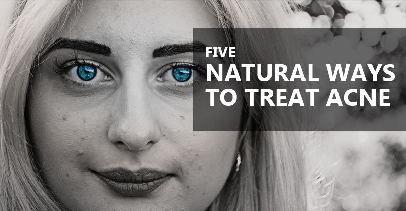 5 natural ways to treat acne