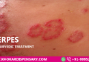 Herpes & Ayurvedic Treatment