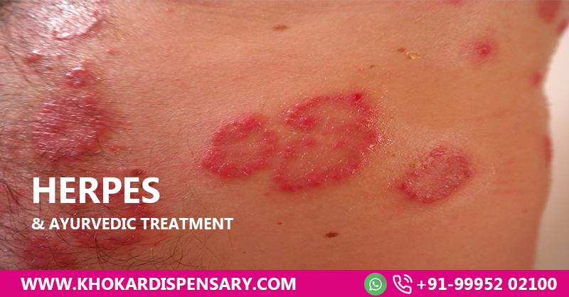 Herpes & Ayurvedic Treatment