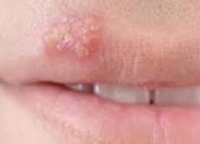 HSV1 - Oral Herpes