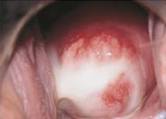 Chlamydial infection of Cervix