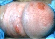 syphilitic sore on Penis