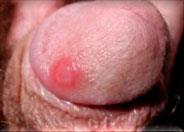syphilitic sore on Penis