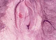 syphilitic sore on Vagina