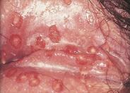 Genital Herpes Sores